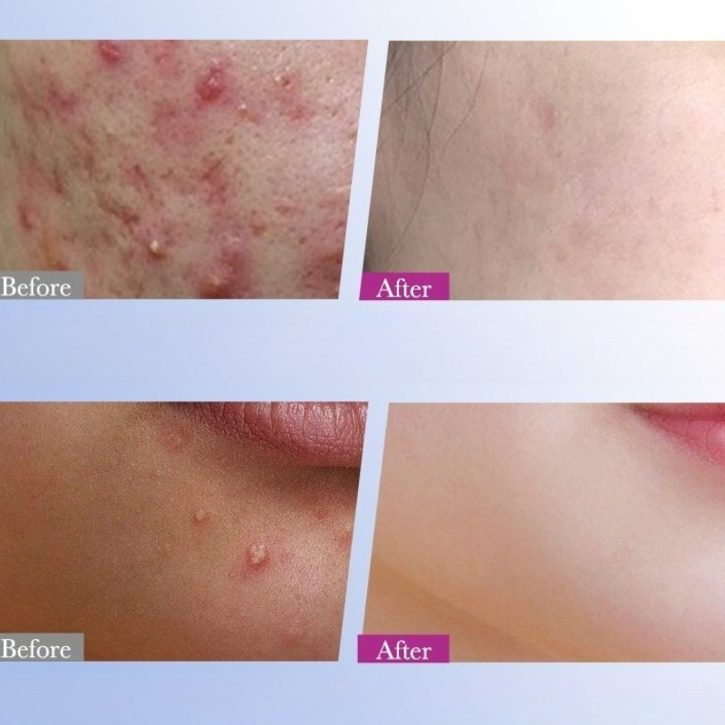 7/10/14Pcs Colorful Star Acne  – обзор и цена Skincare Qv