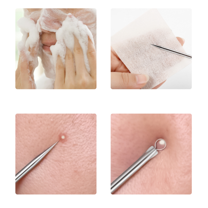 4pcs/set Acne Removal Needles  – обзор и цена Skincare Qv