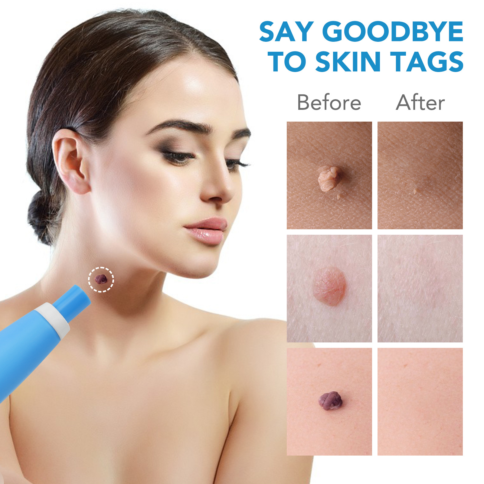 2 IN 1 Auto Skin Tag Remover K – обзор и цена Skincare Qv